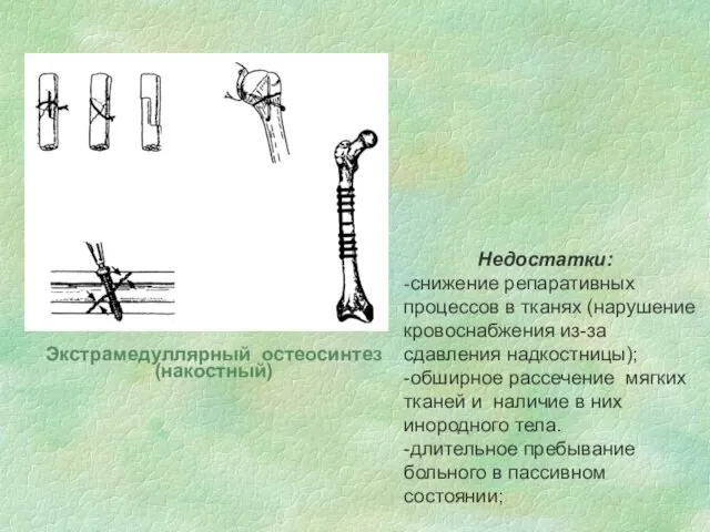 Недостатки: -снижение репаративных процессов в тканях (нарушение кровоснабжения из-за сдавления надкостницы); -обширное
