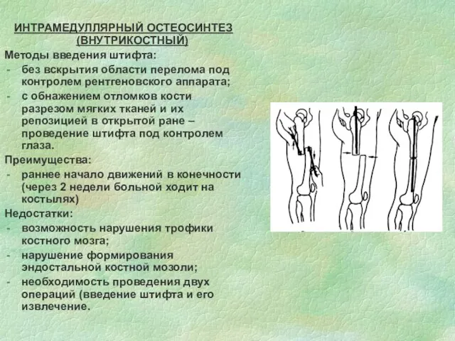 ИНТРАМЕДУЛЛЯРНЫЙ ОСТЕОСИНТЕЗ (ВНУТРИКОСТНЫЙ) Методы введения штифта: без вскрытия области перелома под контролем