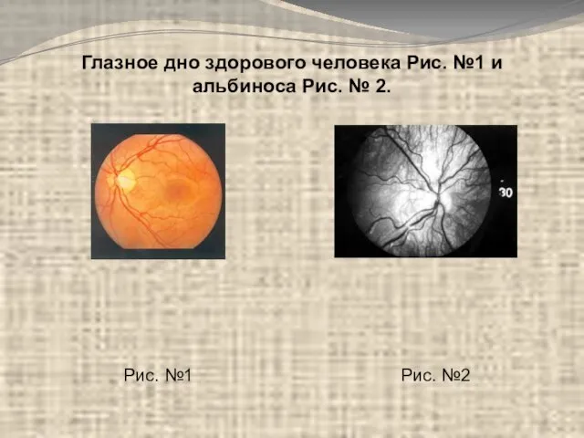 Глазное дно здорового человека Рис. №1 и альбиноса Рис. № 2. Рис. №1 Рис. №2