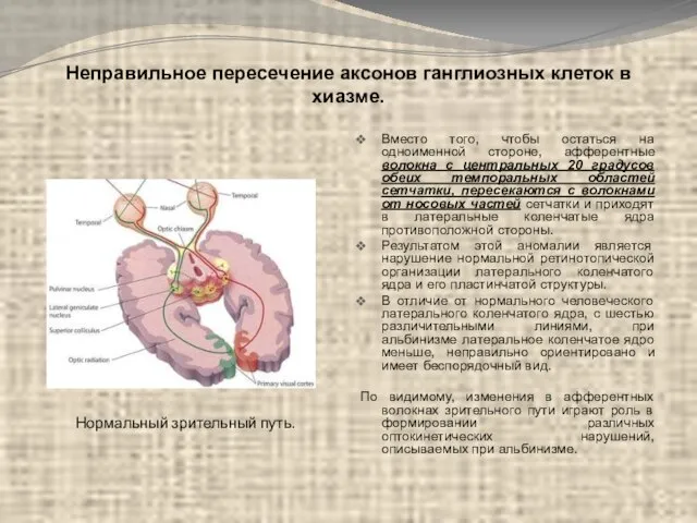 Неправильное пересечение аксонов ганглиозных клеток в хиазме. Вместо того, чтобы остаться на