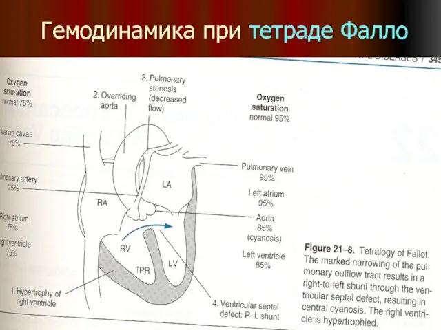 Гемодинамика при тетраде Фалло