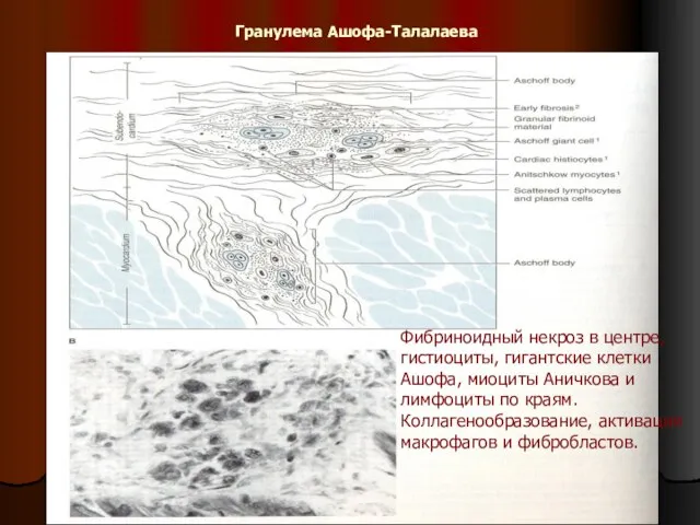 Гранулема Ашофа-Талалаева Фибриноидный некроз в центре, гистиоциты, гигантские клетки Ашофа, миоциты Аничкова