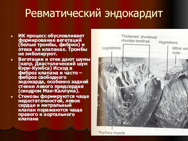 Ревматический эндокардит ИК процесс обусловливает формирование вегетаций (белые тромбы, фибрин) и отека