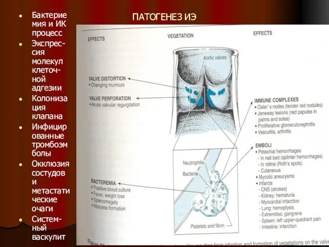 ПАТОГЕНЕЗ ИЭ Бактериемия и ИК процесс Экспрес-сия молекул клеточ-ной адгезии Колонизация клапана