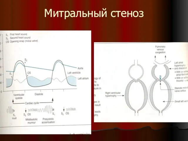 Митральный стеноз