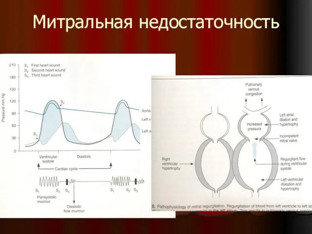 Митральная недостаточность