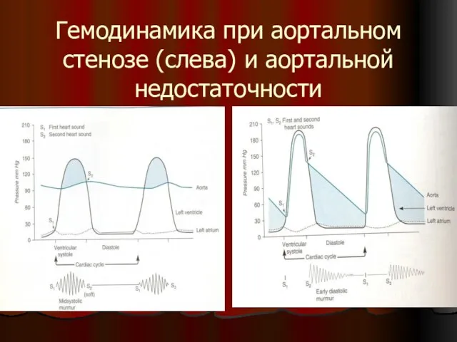 Гемодинамика при аортальном стенозе (слева) и аортальной недостаточности