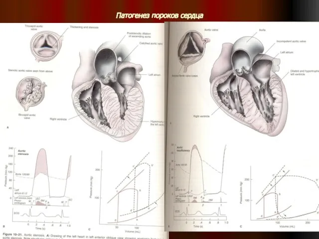 Патогенез пороков сердца