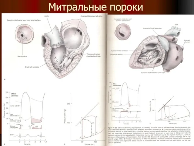 Митральные пороки