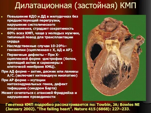 Дилатационная (застойная) КМП Повышение КДО и ДД в желудочках без предшествующей перегрузки,