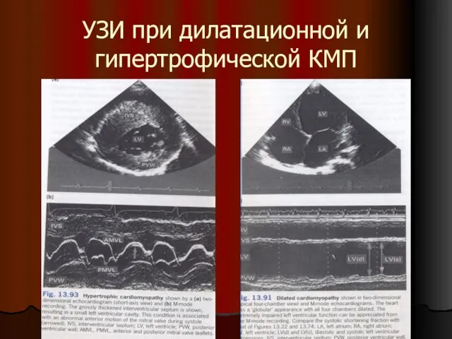 УЗИ при дилатационной и гипертрофической КМП