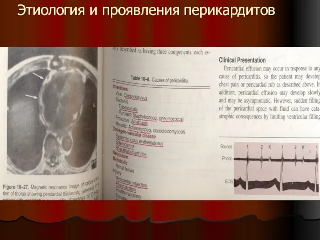 Этиология и проявления перикардитов