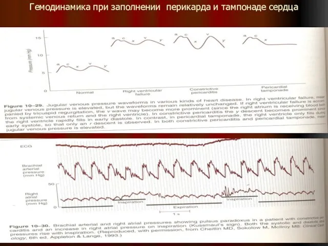 Гемодинамика при заполнении перикарда и тампонаде сердца