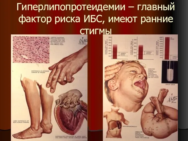 Гиперлипопротеидемии – главный фактор риска ИБС, имеют ранние стигмы