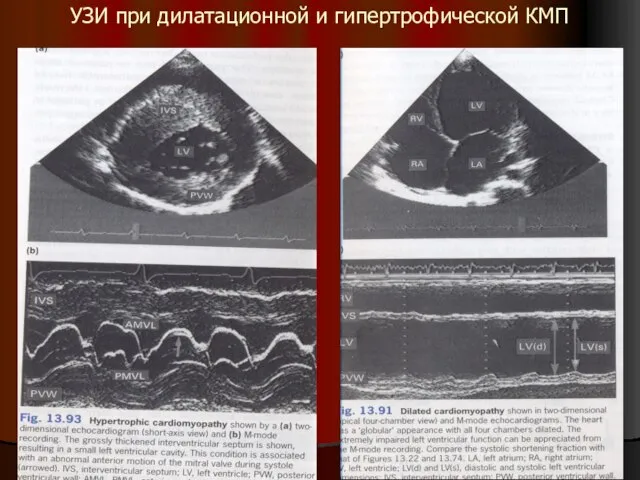 УЗИ при дилатационной и гипертрофической КМП