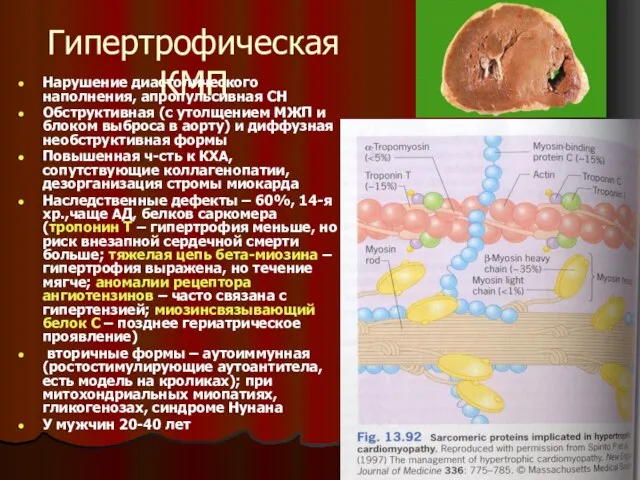 Гипертрофическая КМП Нарушение диастолического наполнения, апропульсивная СН Обструктивная (с утолщением МЖП и