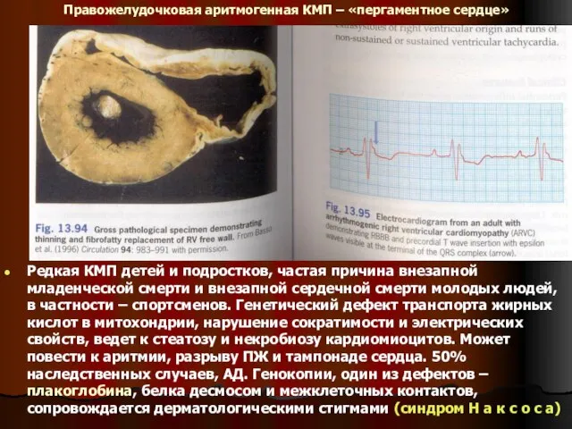 Правожелудочковая аритмогенная КМП – «пергаментное сердце» Редкая КМП детей и подростков, частая