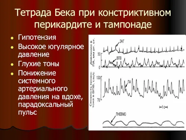 Тетрада Бека при констриктивном перикардите и тампонаде Гипотензия Высокое югулярное давление Глухие