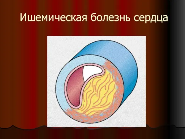 Ишемическая болезнь сердца