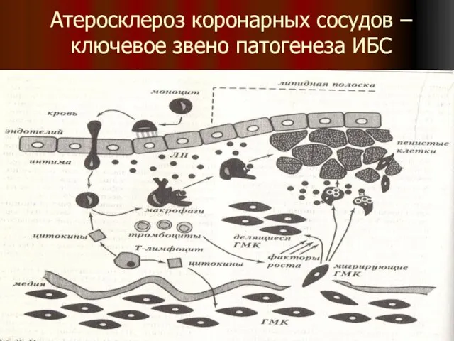 Атеросклероз коронарных сосудов – ключевое звено патогенеза ИБС