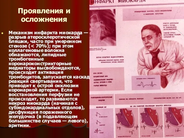 Проявления и осложнения Механизм инфаркта миокарда — разрыв атеросклеротической бляшки, часто при умеренном стенозе (