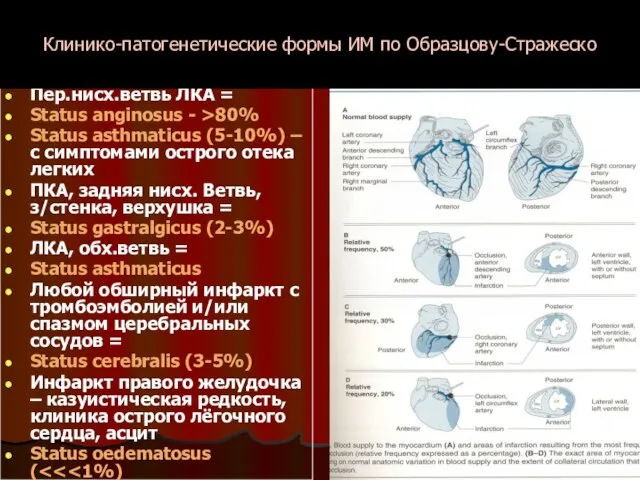 Пер.нисх.ветвь ЛКА = Status anginosus - >80% Status asthmaticus (5-10%) – c