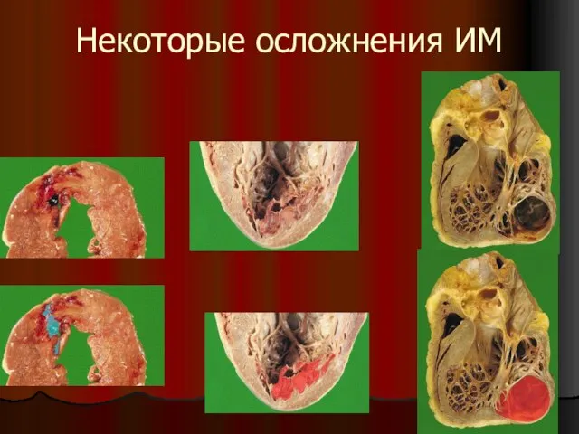 Некоторые осложнения ИМ