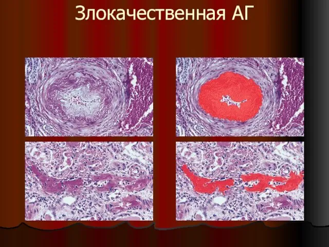 Злокачественная АГ