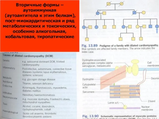 Вторичные формы – аутоиммунная (аутоантитела к этим белкам), пост-миокардитическая и ряд метаболических