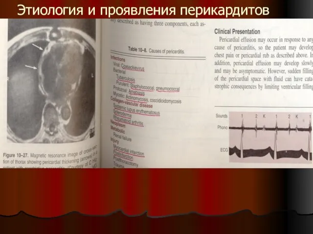 Этиология и проявления перикардитов