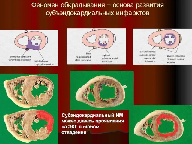 Феномен обкрадывания – основа развития субъэндокардиальных инфарктов Субэндокардиальный ИМ может давать проявления