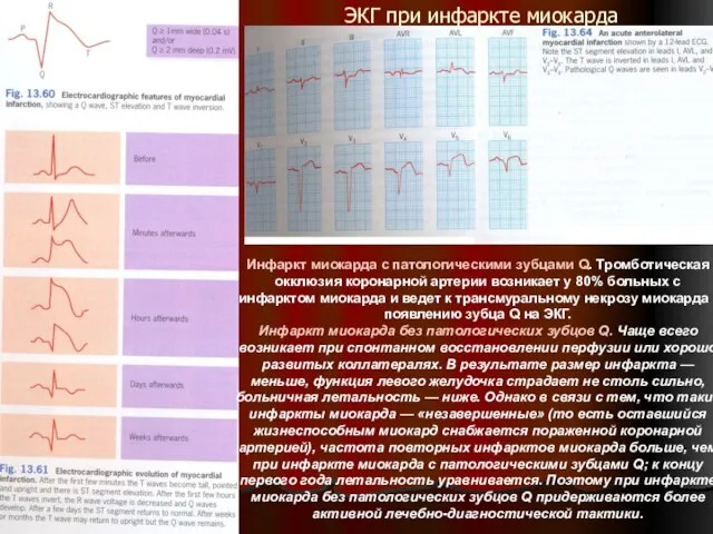 ЭКГ при инфаркте миокарда Инфаркт миокарда с патологическими зубцами Q. Тромботическая окклюзия