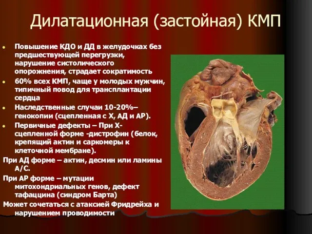 Дилатационная (застойная) КМП Повышение КДО и ДД в желудочках без предшествующей перегрузки,