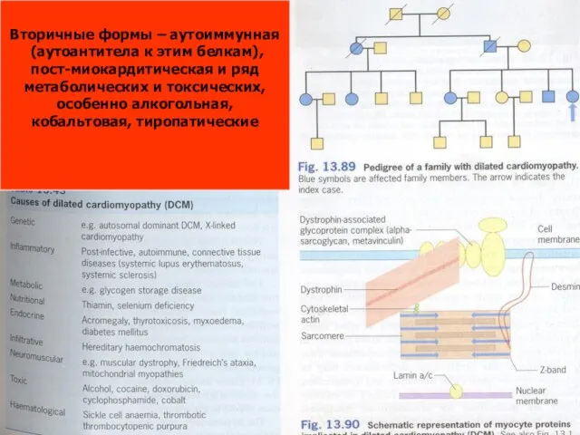 Вторичные формы – аутоиммунная (аутоантитела к этим белкам), пост-миокардитическая и ряд метаболических