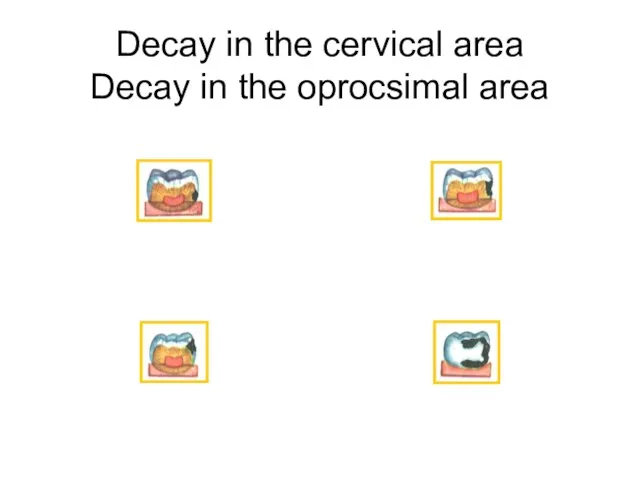 Decay in the cervical area Decay in the oprocsimal area