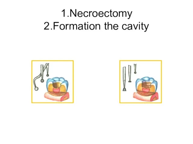 1.Necroectomy 2.Formation the cavity