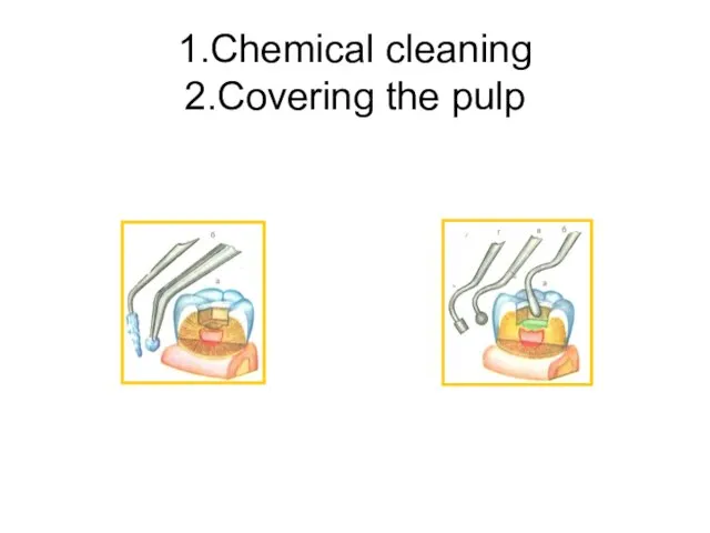 1.Chemical cleaning 2.Covering the pulp