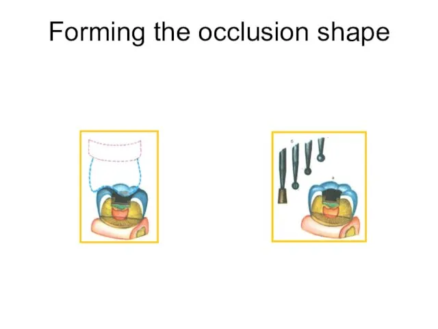 Forming the occlusion shape