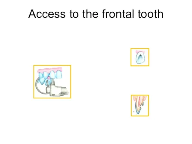 Access to the frontal tooth