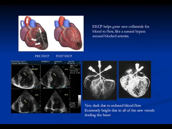 PRE EECP POST EECP Very dark due to reduced blood flow Extremely
