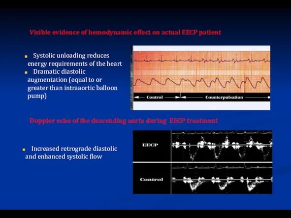 Visible evidence of hemodynamic effect on actual EECP patient Systolic unloading reduces
