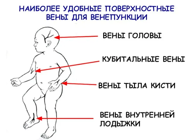 НАИБОЛЕЕ УДОБНЫЕ ПОВЕРХНОСТНЫЕ ВЕНЫ ДЛЯ ВЕНЕПУНКЦИИ ВЕНЫ ГОЛОВЫ КУБИТАЛЬНЫЕ ВЕНЫ ВЕНЫ ТЫЛА КИСТИ ВЕНЫ ВНУТРЕННЕЙ ЛОДЫЖКИ