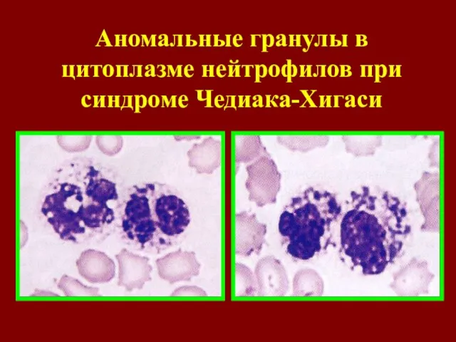 Аномальные гранулы в цитоплазме нейтрофилов при синдроме Чедиака-Хигаси