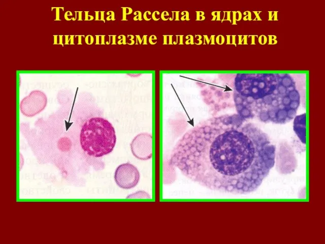 Тельца Рассела в ядрах и цитоплазме плазмоцитов