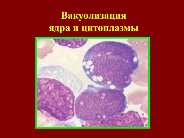 Вакуолизация ядра и цитоплазмы