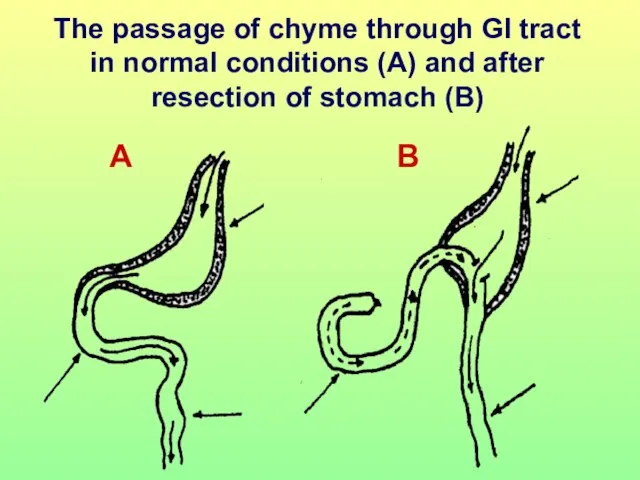 The passage of chyme through GI tract in normal conditions (A) and