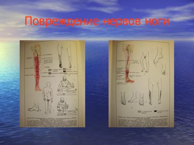 Повреждение нервов ноги