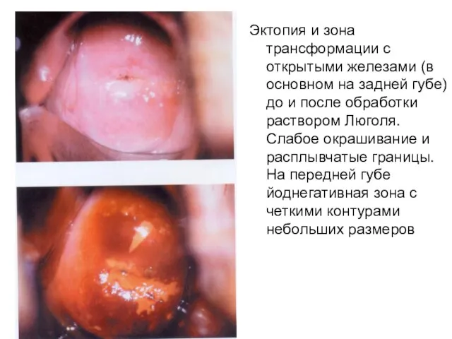 Эктопия и зона трансформации с открытыми железами (в основном на задней губе)