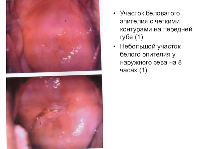 Участок беловатого эпителия с четкими контурами на передней губе (1) Небольшой участок