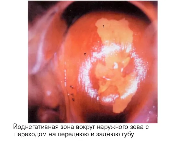 Йоднегативная зона вокруг наружного зева с переходом на переднюю и заднюю губу